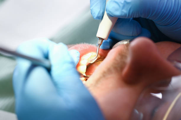 Best Emergency Root Canal Treatment in Cascades, VA